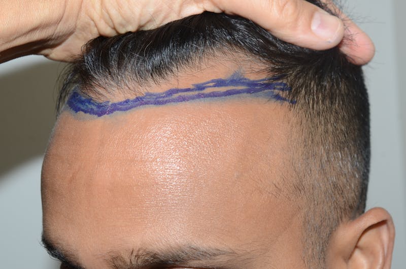 Hair Restoration for Men Before & After Gallery - Patient 143607 - Image 3