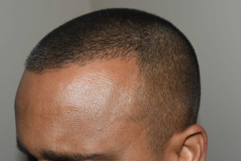 Hair Restoration for Men Before & After Gallery - Patient 422567 - Image 7