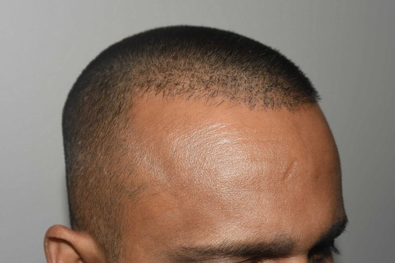 Hair Restoration for Men Before & After Gallery - Patient 422567 - Image 10
