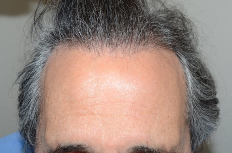 Hair Restoration for Men Before & After Gallery - Patient 204335 - Image 1