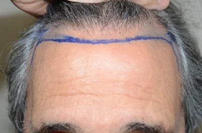Hair Restoration for Men Before & After Gallery - Patient 316097 - Image 2