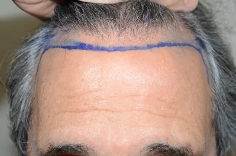 Hair Restoration for Men Before & After Gallery - Patient 633185 - Image 1