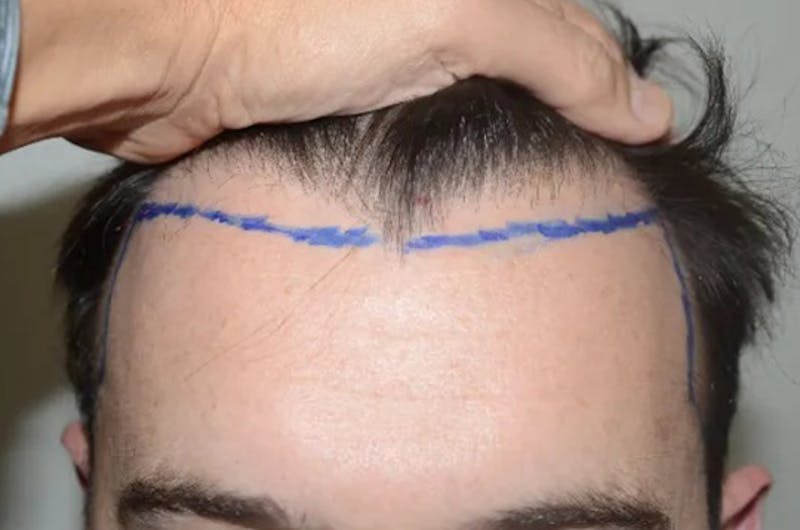 Hair Restoration for Men Before & After Gallery - Patient 117114 - Image 1