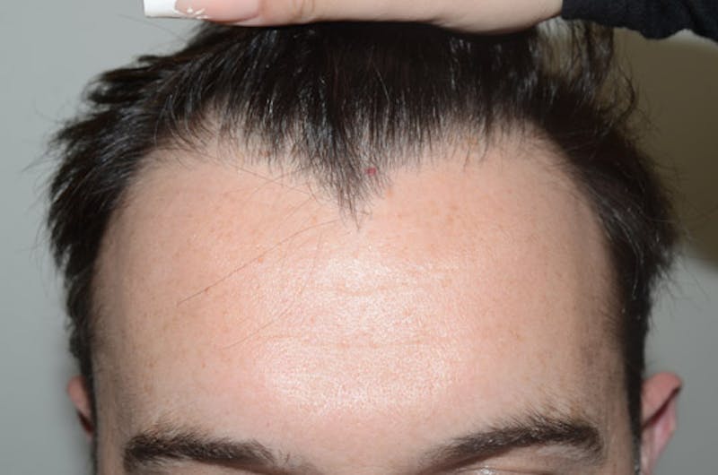 Hair Restoration for Men Before & After Gallery - Patient 110654 - Image 1