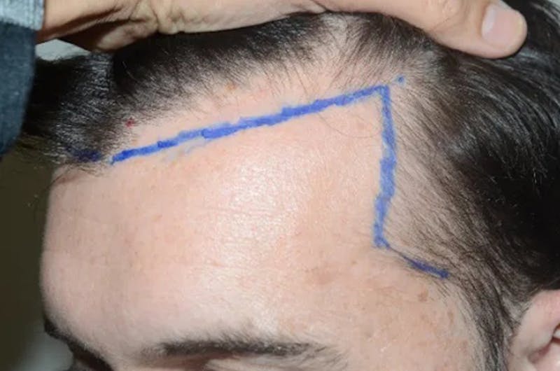 Hair Restoration for Men Before & After Gallery - Patient 117114 - Image 4