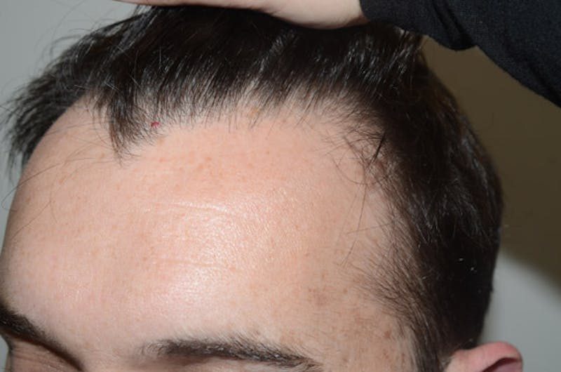 Hair Restoration for Men Before & After Gallery - Patient 110654 - Image 3