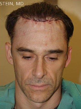 Hair Transplant Repair Before & After Gallery - Patient 578064 - Image 2