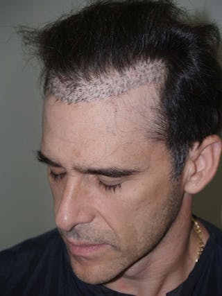 Hair Transplant Repair Before & After Gallery - Patient 578064 - Image 4
