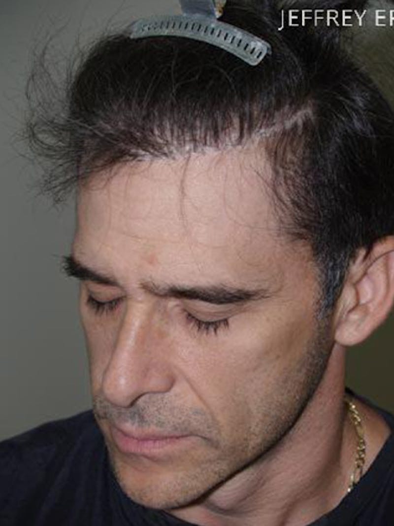 Hair Restoration for Men Before & After Gallery - Patient 825232 - Image 3