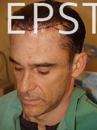 Hair Transplant Repair Before & After Gallery - Patient 578064 - Image 6