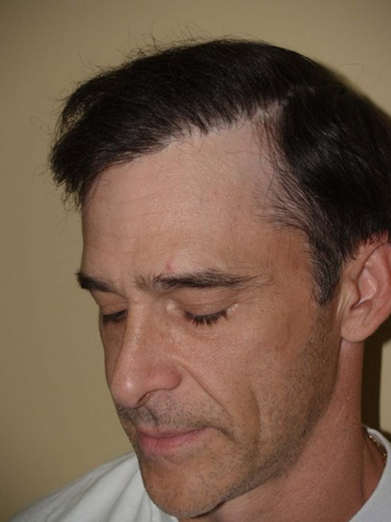 Hair Restoration for Men Before & After Gallery - Patient 825232 - Image 4