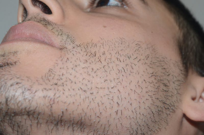 Hair Transplant Repair Before & After Gallery - Patient 255194 - Image 1