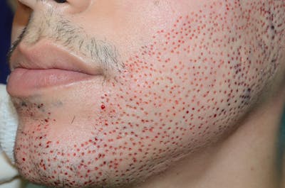 Facial Hair Transplant Before & After Gallery - Patient 268498 - Image 2
