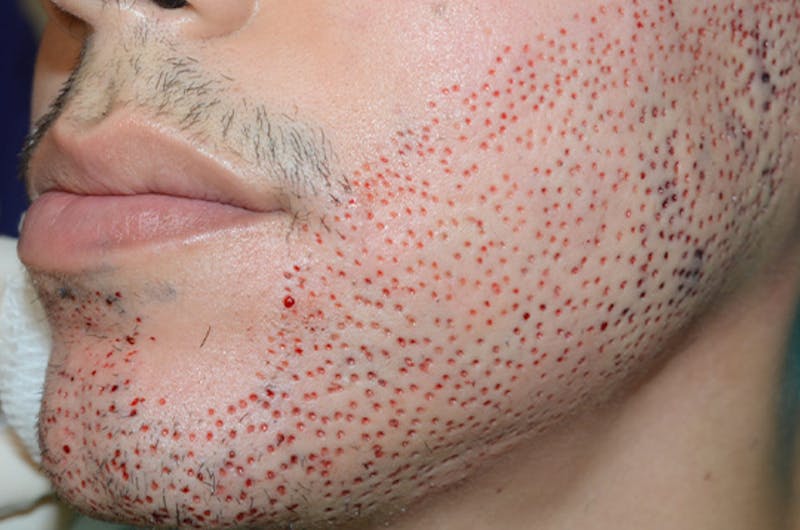 Hair Restoration for Men Before & After Gallery - Patient 212321 - Image 1