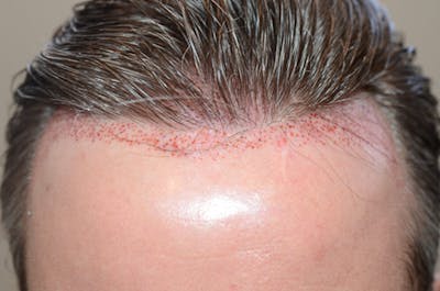 Hair Transplant Repair Before & After Gallery - Patient 119367 - Image 2