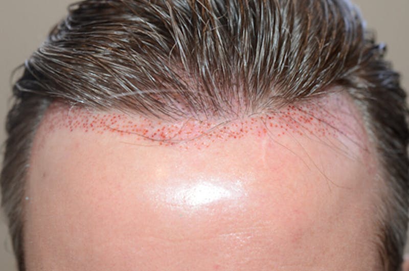 Hair Transplant Repair Before & After Gallery - Patient 345023 - Image 2
