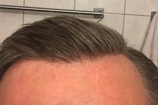 Hair Restoration for Men Before & After Gallery - Patient 427466 - Image 2