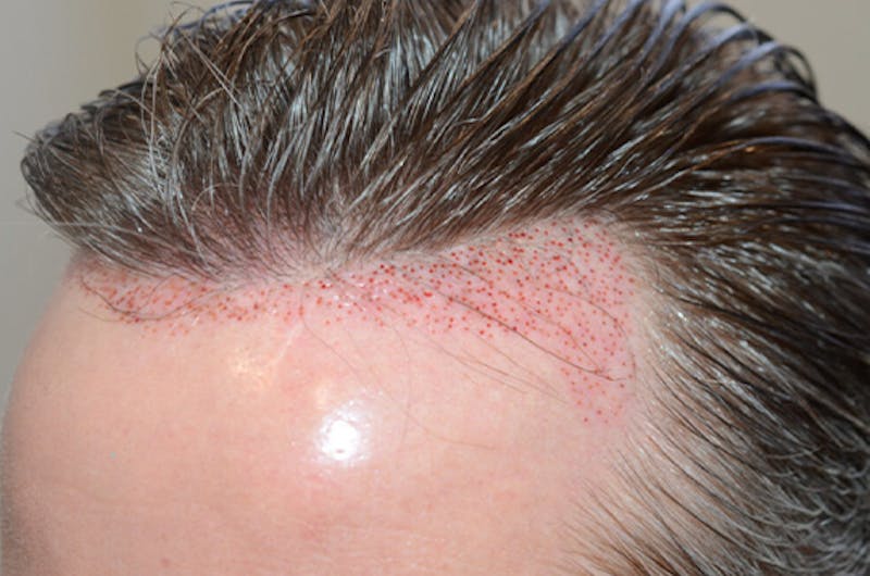 Hair Transplant Repair Before & After Gallery - Patient 345023 - Image 5