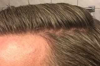 Hair Restoration for Men Before & After Gallery - Patient 427466 - Image 4