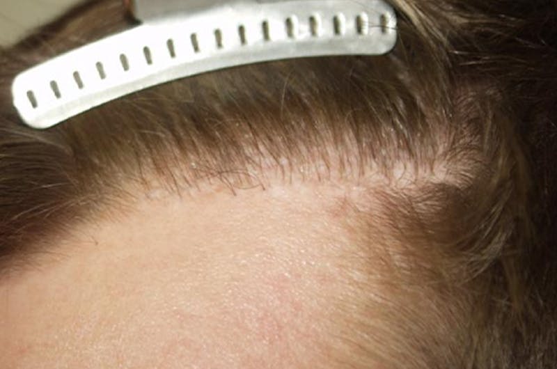 Hair Restoration for Men Before & After Gallery - Patient 356583 - Image 3