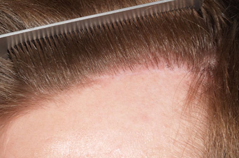 Hair Transplant Repair Before & After Gallery - Patient 604952 - Image 5