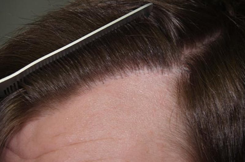 Hair Restoration for Men Before & After Gallery - Patient 356583 - Image 4