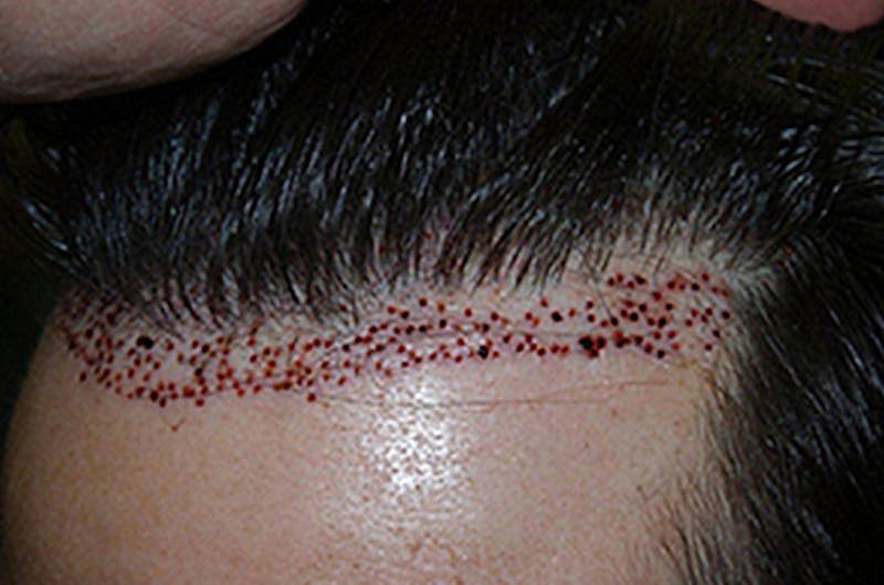Hair Transplant Repair Before & After Gallery - Patient 154978 - Image 8