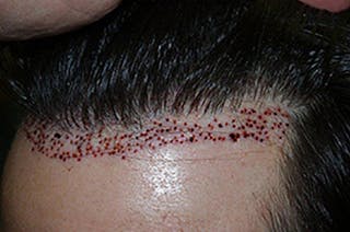 Hair Transplant Repair Before & After Gallery - Patient 370381 - Image 8