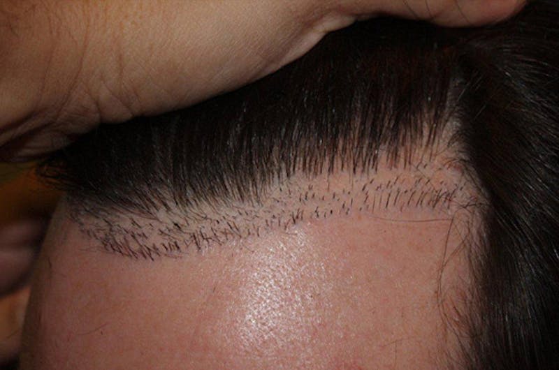 Hair Restoration for Men Before & After Gallery - Patient 222650 - Image 8
