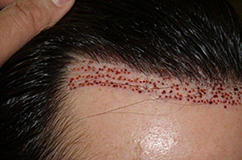Hair Transplant Repair Before & After Gallery - Patient 154978 - Image 11