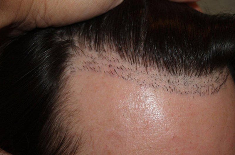 Hair Restoration for Men Before & After Gallery - Patient 222650 - Image 10
