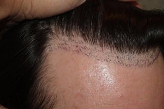 Hair Transplant Repair Before & After Gallery - Patient 370381 - Image 12