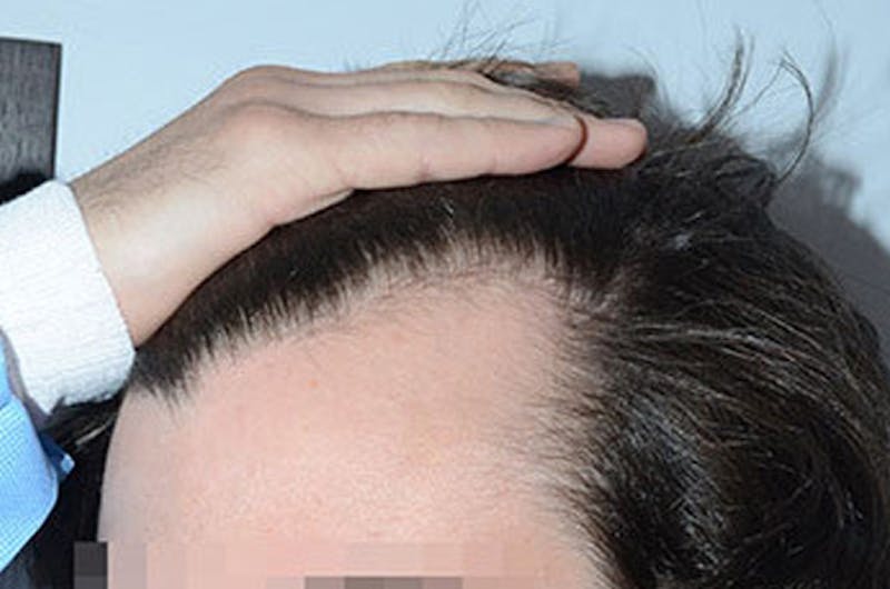 Hair Restoration for Men Before & After Gallery - Patient 316334 - Image 3