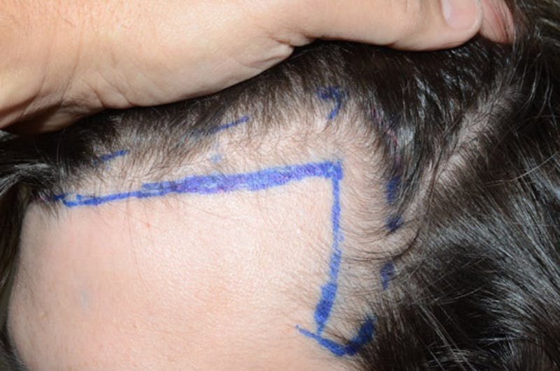 Hair Restoration for Men Before & After Gallery - Patient 239786 - Image 3