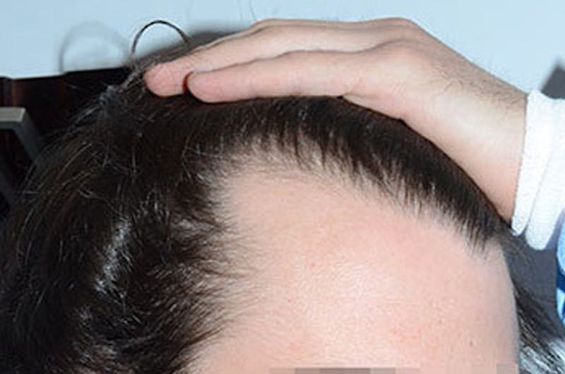Hair Restoration for Men Before & After Gallery - Patient 316334 - Image 6