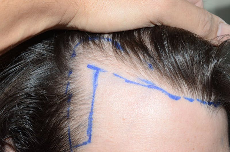 Hair Restoration for Men Before & After Gallery - Patient 239786 - Image 5