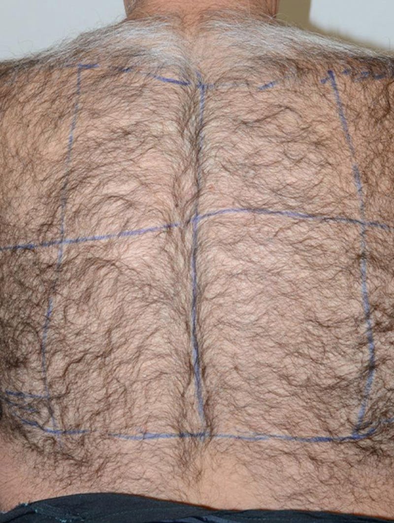 Close-up Donor Sites Before & After Gallery - Patient 258547 - Image 5