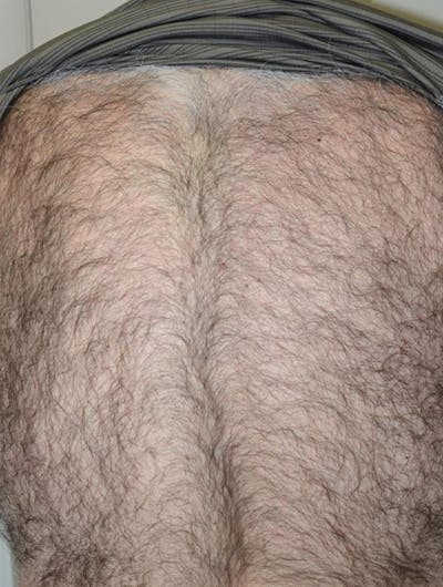 Body Hair Transplants Before & After Gallery - Patient 176729 - Image 2