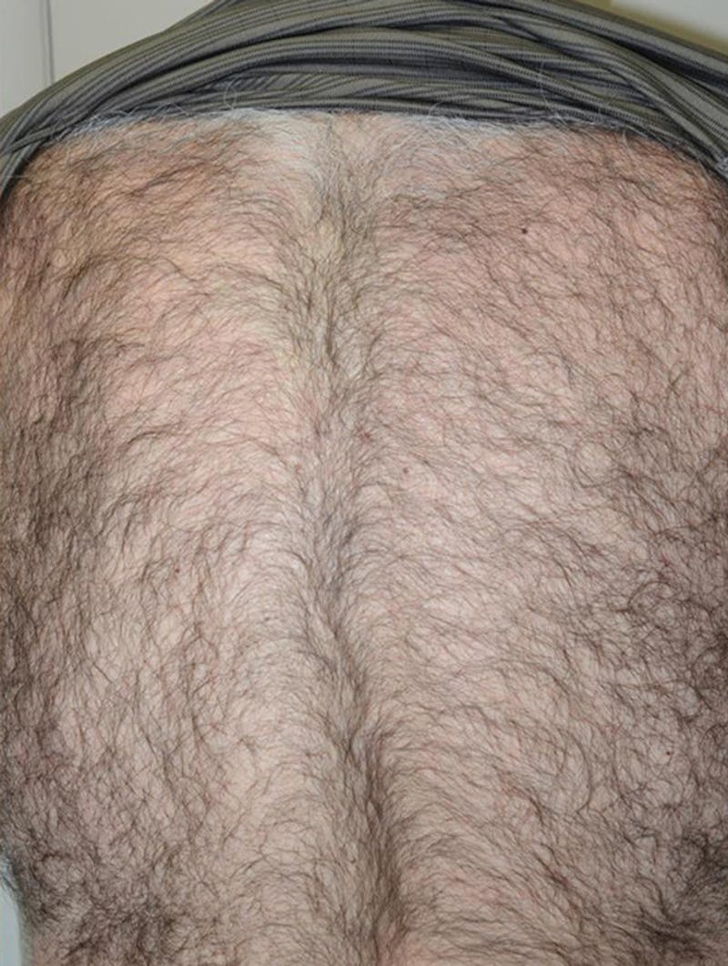 Close-up Donor Sites Before & After Gallery - Patient 258547 - Image 6
