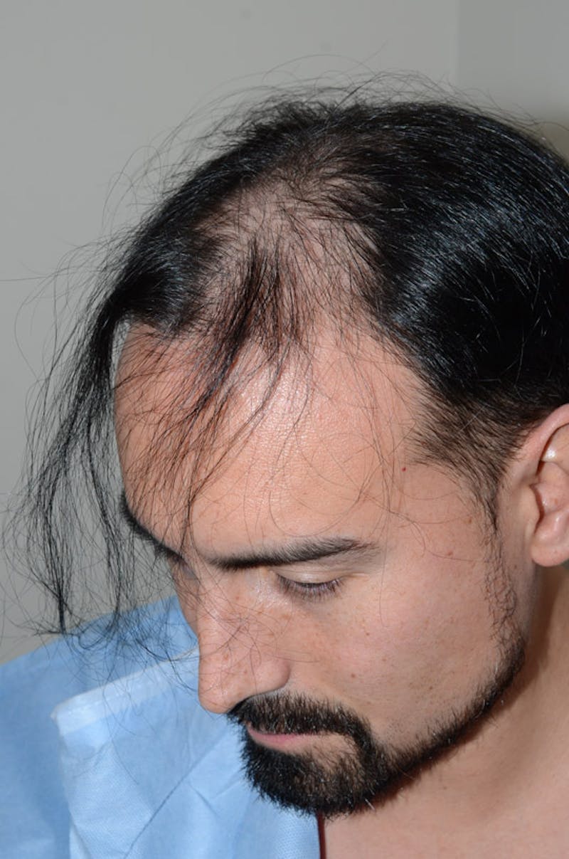 Hair Restoration for Men Before & After Gallery - Patient 947480 - Image 3