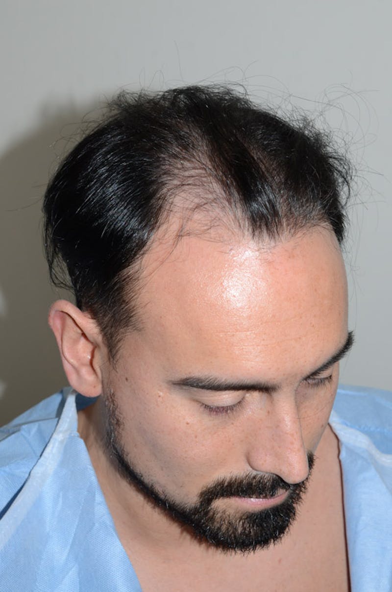 Hair Restoration for Men Before & After Gallery - Patient 947480 - Image 5