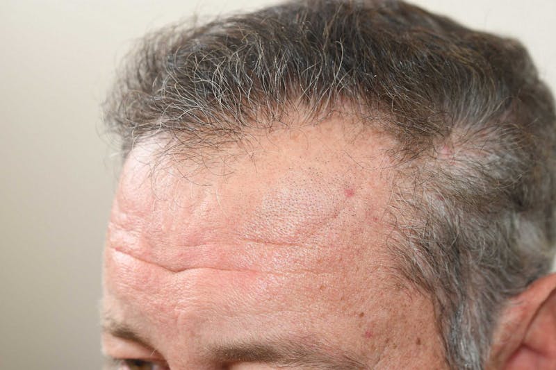 Hair Restoration for Men Before & After Gallery - Patient 336145 - Image 4