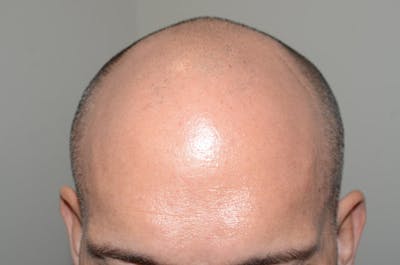 Hair Restoration for Men Before & After Gallery - Patient 290873 - Image 1