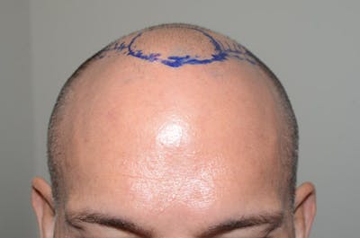 Hair Restoration for Men Before & After Gallery - Patient 290873 - Image 2