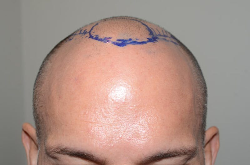 Hair Restoration for Men Before & After Gallery - Patient 118330 - Image 1