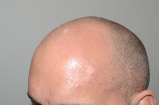Hair Restoration for Men Before & After Gallery - Patient 290873 - Image 4