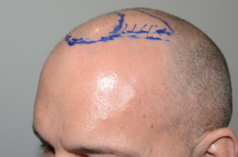 Hair Restoration for Men Before & After Gallery - Patient 118330 - Image 3