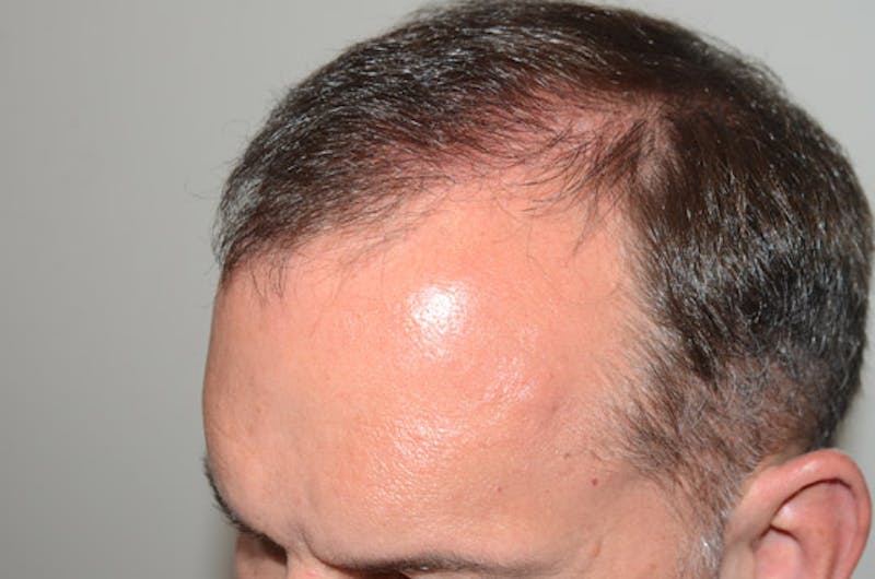 Hair Restoration for Men Before & After Gallery - Patient 167905 - Image 6