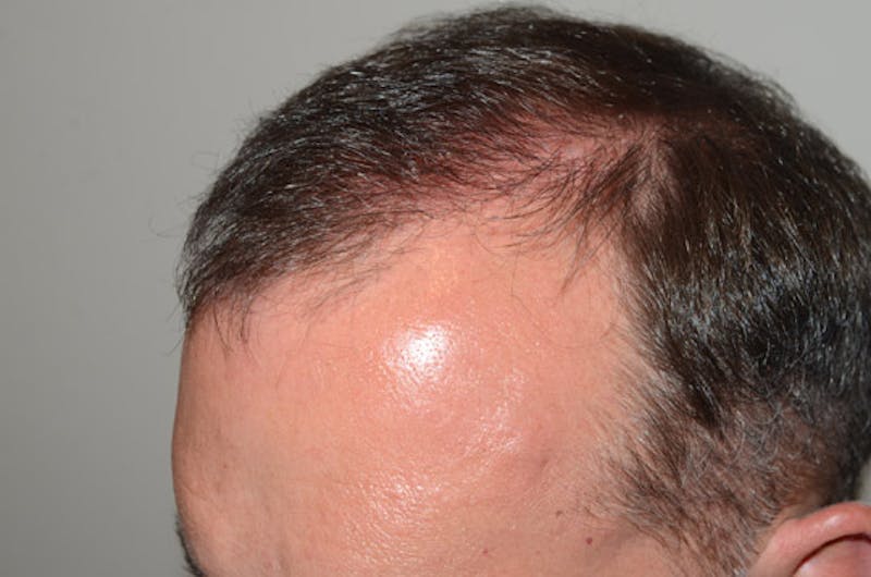 Hair Restoration for Men Before & After Gallery - Patient 118330 - Image 4