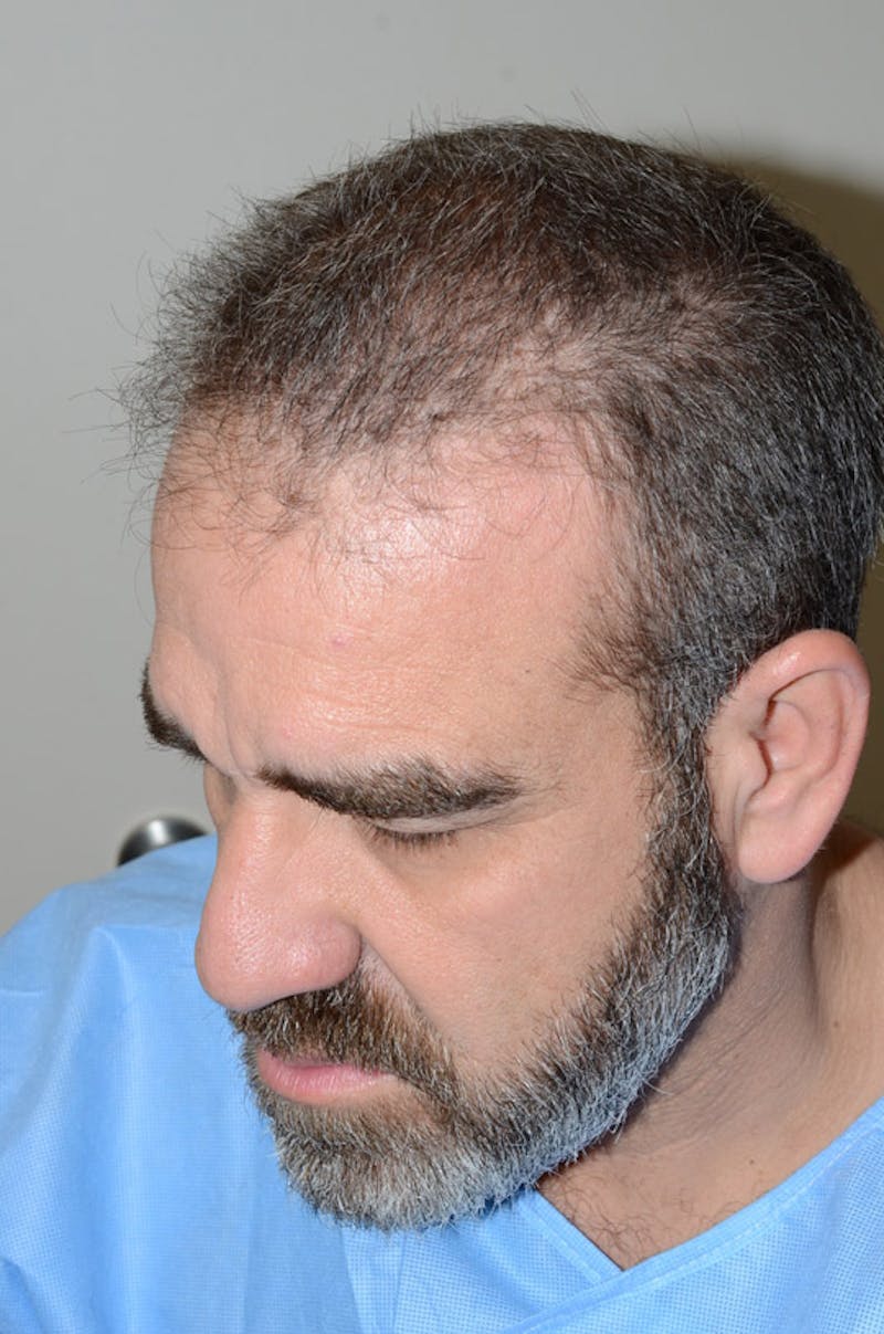 Hair Restoration for Men Before & After Gallery - Patient 105497 - Image 3